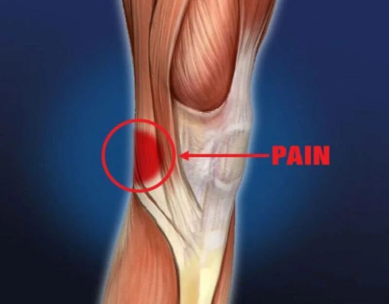 тендовагинит сухожилия двуглавой мышцы. локоть теннисиста латеральный эпикондилит. эпикандилитлоктекого сустава. сухожилия надостной мышцы плечевого сустава. разрыв ахиллового сухожилия.