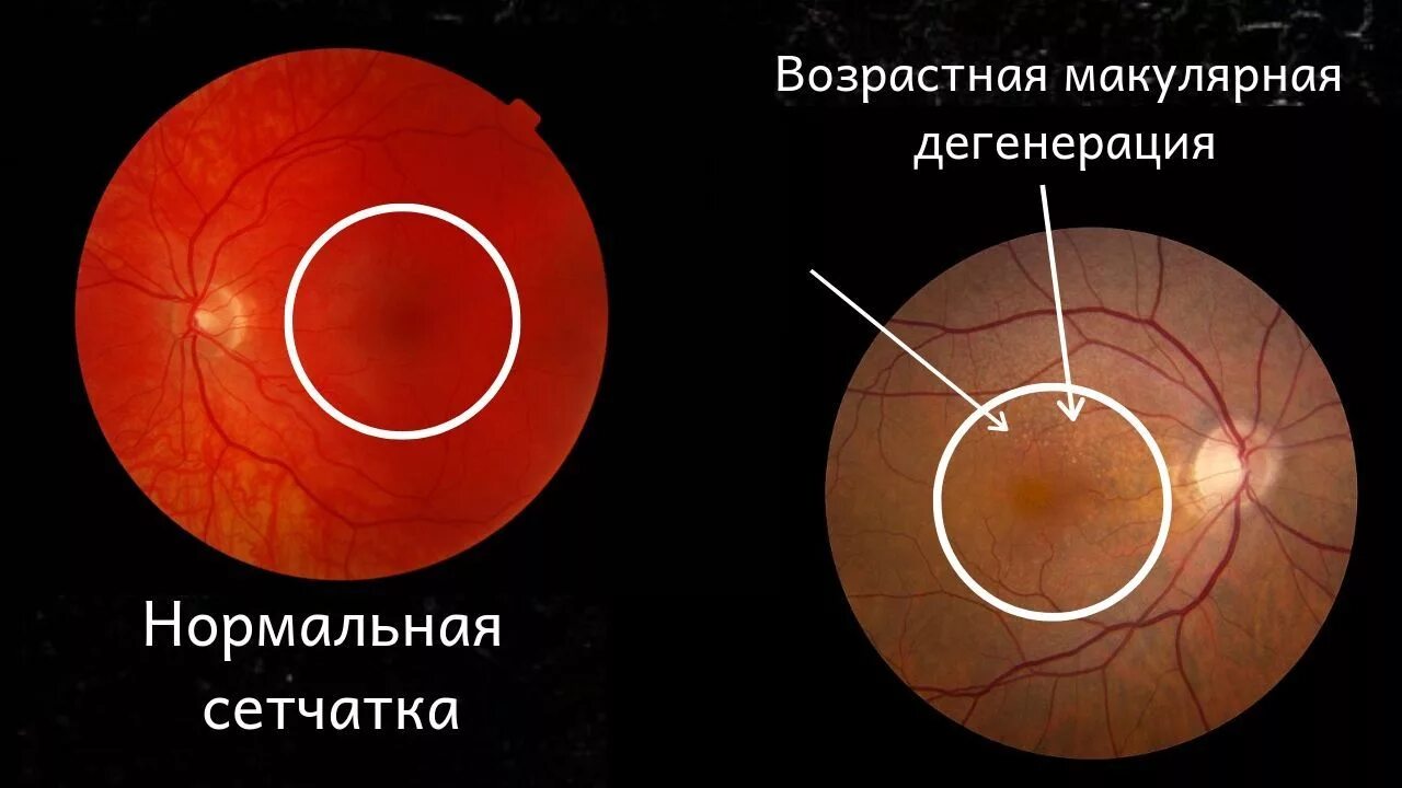 Задний полюс глаза. Макулярной дистрофии сетчатки. Макула дистрофия сетчатки глаза. Возрастная макулярная дегенерация сетчатки глаза. Возрастная макулодистрофия глазное дно.