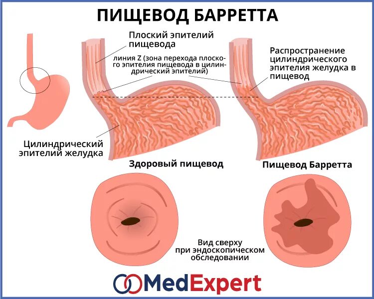 Пищевод проходим. Пищевод Барретта классификация. Гастроэзофагеальная-рефлюксная болезнь ФГДС. Пищевод Барретта клинические проявления.