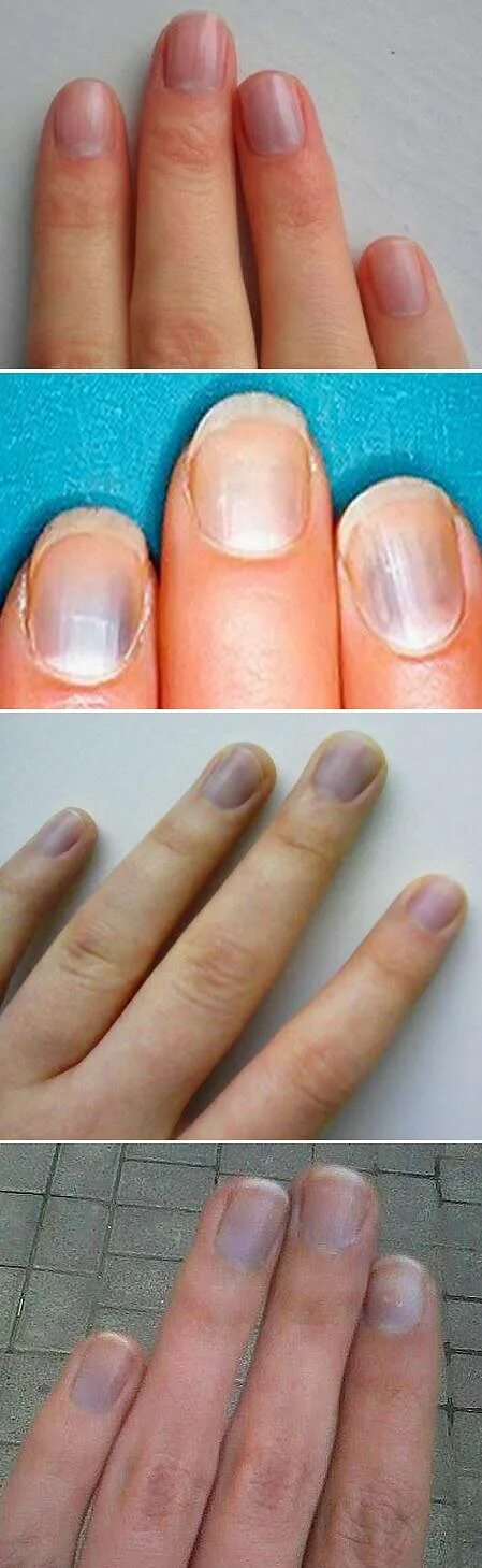 Синюшные ногтевые пластины. Синеватые ногти на руках. Синеватый цвет ногтей ногтевой пластины. Почему посинели ногти