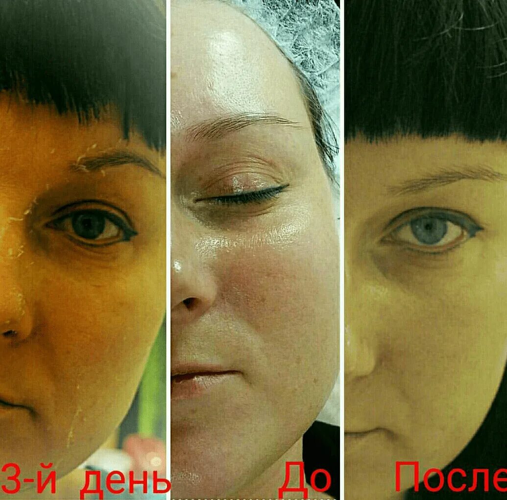 Глубокий фенольный пилинг. Химический пилинг фенол