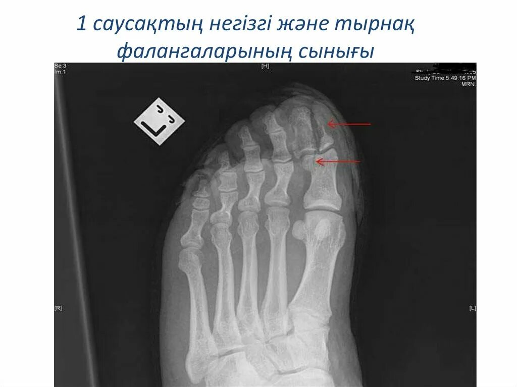Перелом основной фаланги 1 пальца стопы рентген. Перелом основной фаланги рентген. Закрытый краевой перелом ногтевой фаланги 1 пальца правой стопы. Краевой перелом основной фаланги 1 пальца ноги. Ногтевая фаланга ноги