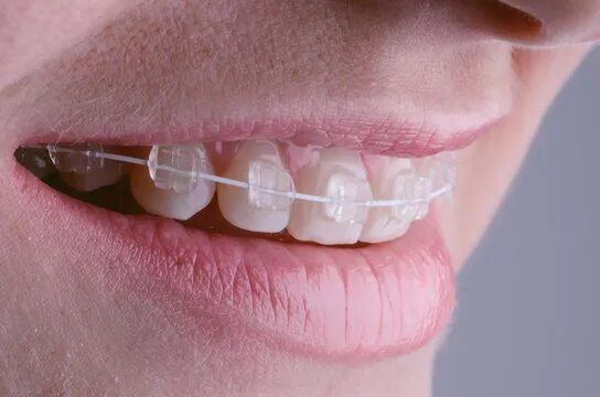 buiten boord beugel - Google zoeken Celebrities with braces, Braces girls, Headg