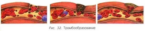 Тромбоз стадии тромбообразования. Кровь, свертывание крови 8 кл биология. Стадии образования тромбоцитарного тромба. Стадии формирования тромбоцитарного тромба. Образование тромба попадание факторов