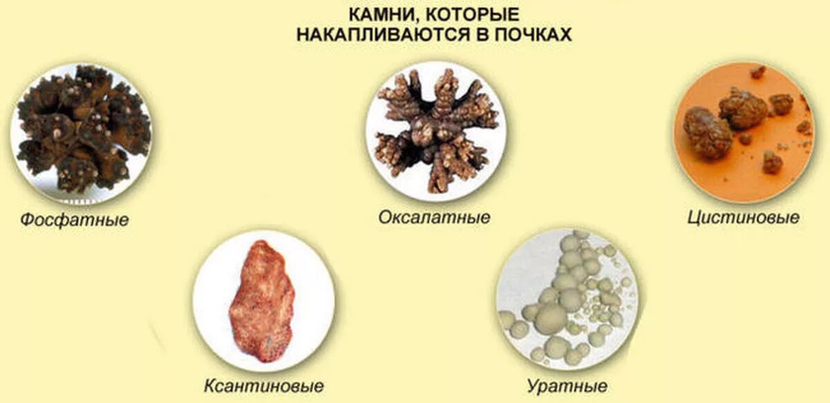 Цистиновые камни причина образования. Мочекаменная болезнь пить воду