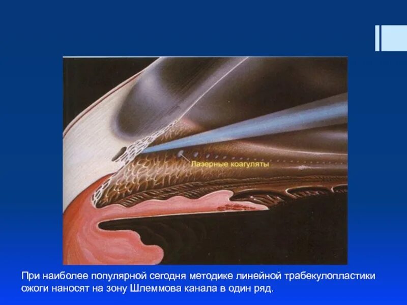 Лазерная трабекулопластика при глаукоме. Лазерная десцеметогониопунктура. Селективная трабекулопластика. Селективная трабекулопластика. Лазерная трабекулопластика при глаукоме.