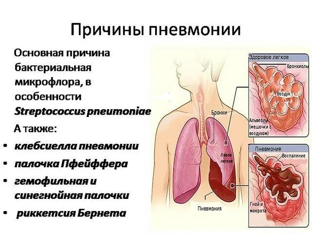 Факторы заболевания пневмонией. Причины пневмонии у взрослых. Пневмония причины симптомы.