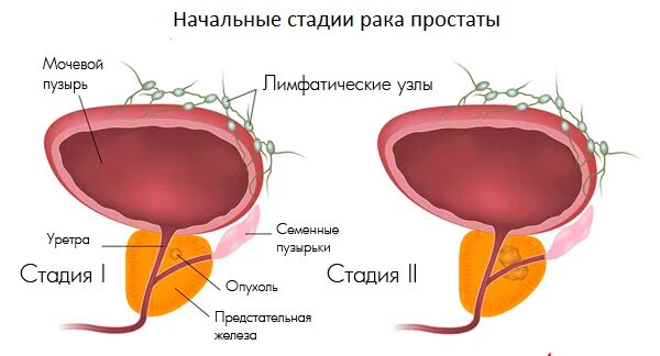 Простата рак симптомы лечение. Стадии онкологии предстательной железы. Cancer предстательной железы. Простата начальная стадия.