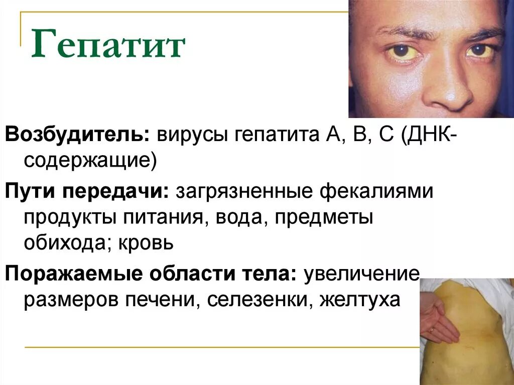 Желтуха заразная или нет. Гепатит возбудитель заболевания. Гепатит а возбудитель пути передачи. Вирусный гепатит желтуха. Вирус гепатита с возбудитель.