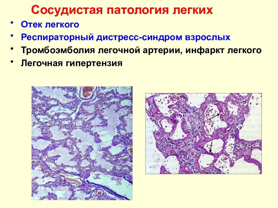 Респираторный дистресс взрослых. Острый респираторный дистресс синдром патанатомия. Тромбоэмболия легочной артерии гистология. Острый респираторный дистресс-синдром гистология. ОРДС патологическая анатомия.