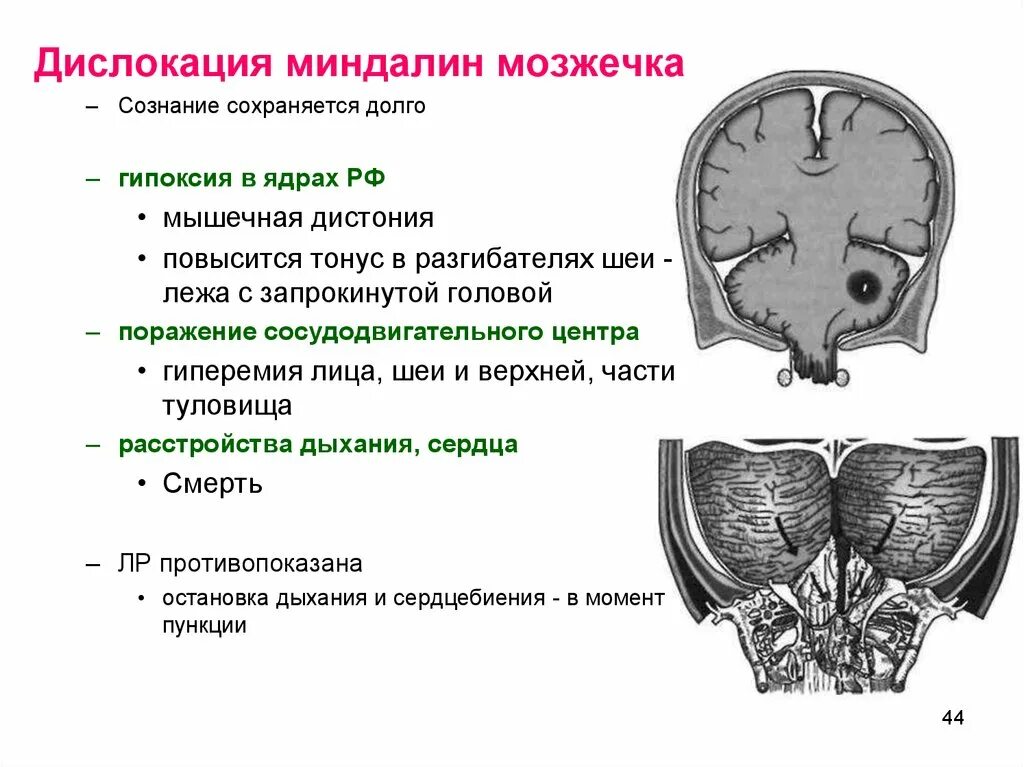 Миндалины мозжечка функции. Вклинение миндалин мозжечка кт. Опухоль мозжечка клиника неврология. Вклинение миндалин мозжечка в продолговатый мозг. Мозжечковая опухоль