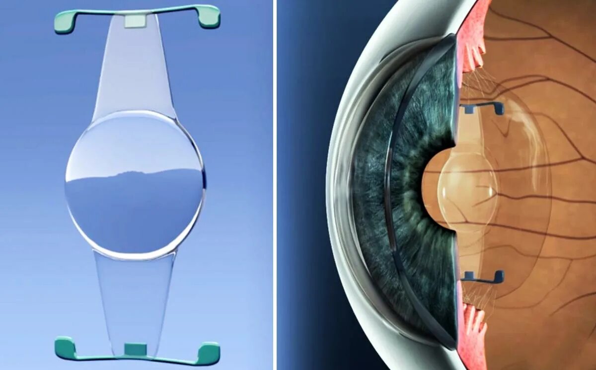 Американские алкон для глаза. Аккомодирующие ИОЛ. Мультифокальные ИОЛ катаракта. Трифокальная интраокулярная линза.