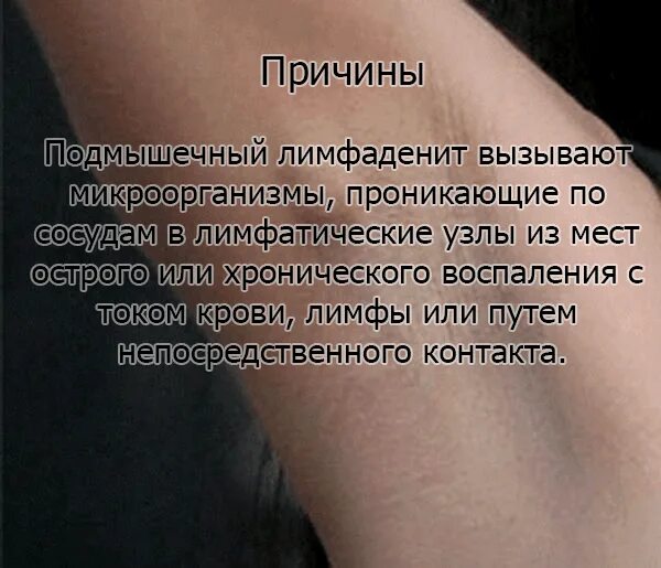 Можно ли воспаленный лимфоузел мазать йодом. Лимфаденит подмышечный. подмышечные лимфатические узлы воспалены. воспаление лимфоузел подмышкой.