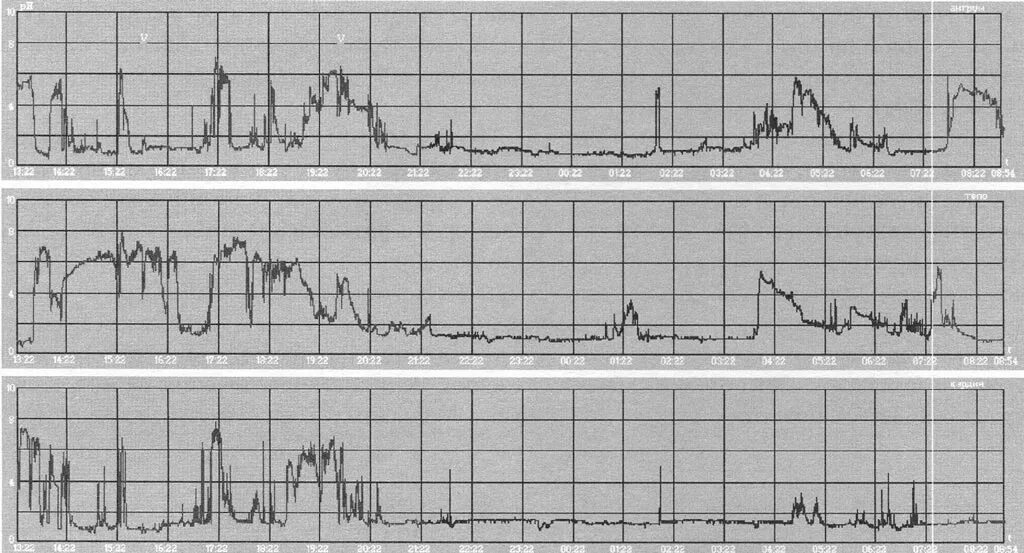 Рн-метрия желудка показатели. Ph метрия желудка график. Пневмограмма при речи. Рн грамма. Рн грамма.