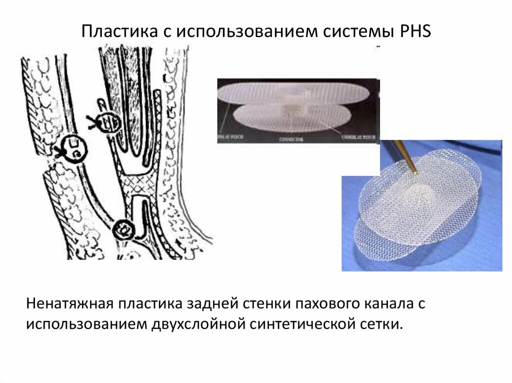 Передне задняя пластика. Операция нейгебауэра лефора. Срединная кольпорафия лефора-нейгебауэра. Передне задняя пластика. Sublay пластика грыжи.