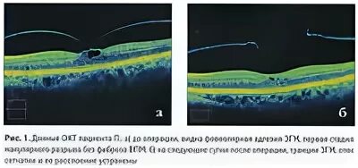 Макулярный разрыв после операции. Тракционный макулярный отек. Ламеллярный макулярный разрыв. Ламеллярный макулярный разрыв сетчатки. Макулярный разрыв окт.