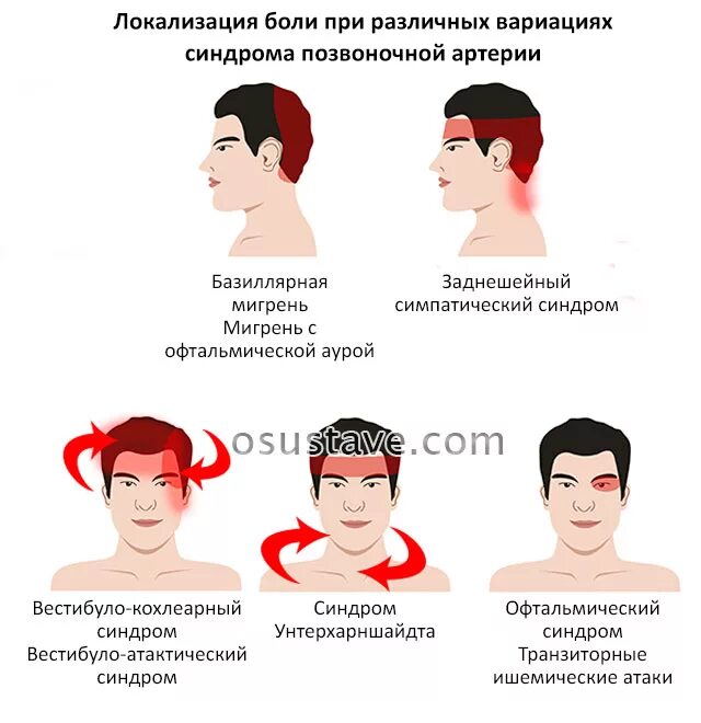 Симптомы сильная головная. Головная боль локализация. Локализация глазной боли. Головная больлоклизация. Локализация головной боли и причины.