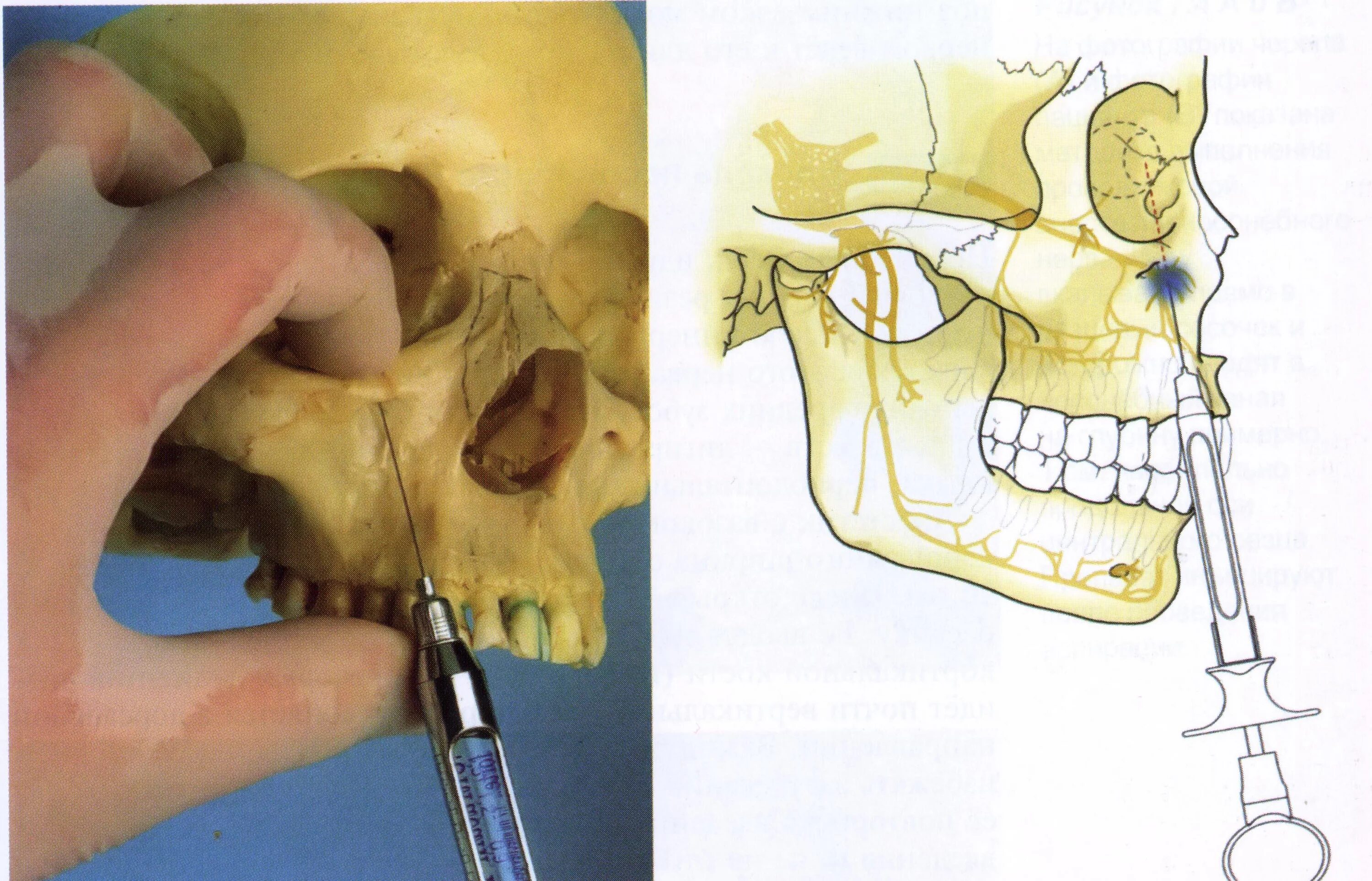 Блокада носа. Туберальная анестезия верхней челюсти. Инфраорбитальная анестезия верхней челюсти. Туберальная анестезия в стоматологии. Туберальная анестезия техника.