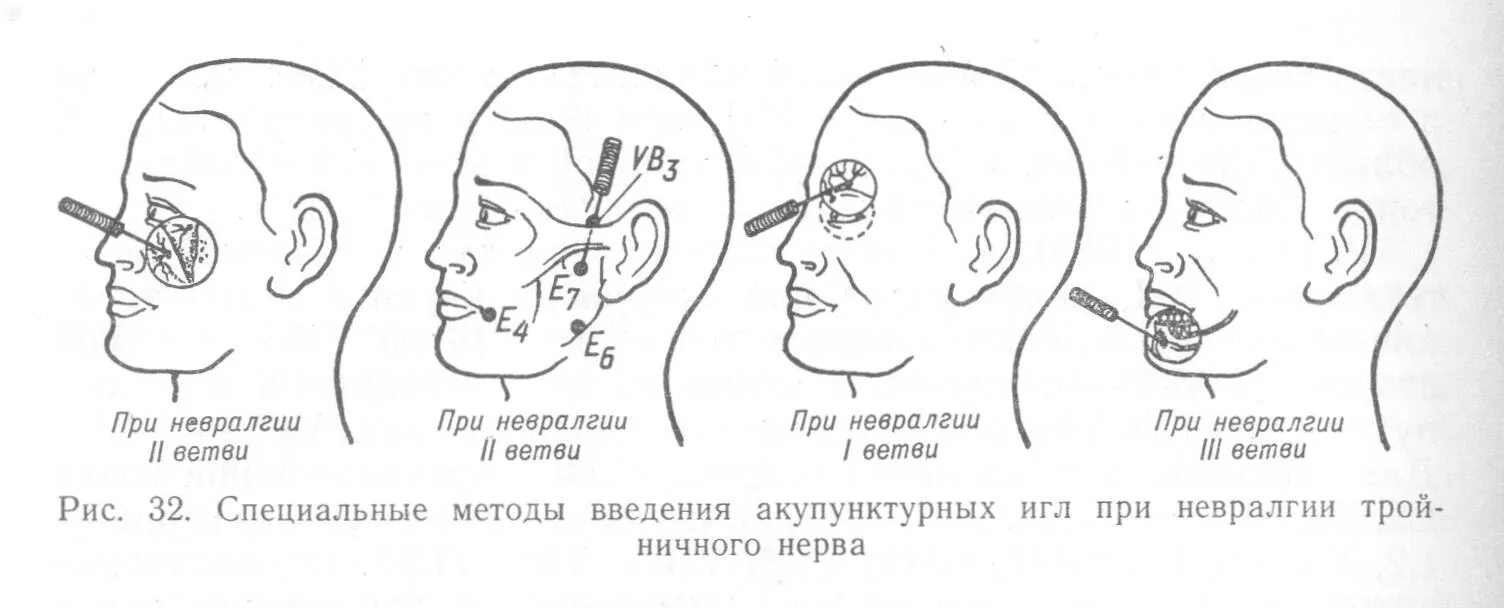 Тройничный нерв воспаление дарсонваль. Иглотерапия при неврите тройничного нерва. Акупунктура при воспалении тройничного нерва. Акупунктура при неврите лицевого нерва.