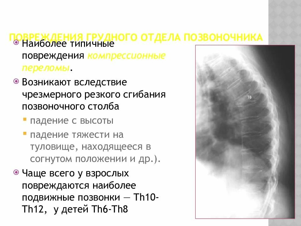 Последствие перелома позвоночника мкб. Мкб 10 компрессионный перелом грудного отдела позвоночника. Травма грудного отдела позвоночника мкб. Перелом грудного позвонка мкб 10. Лучевая диагностика травм головного мозга.