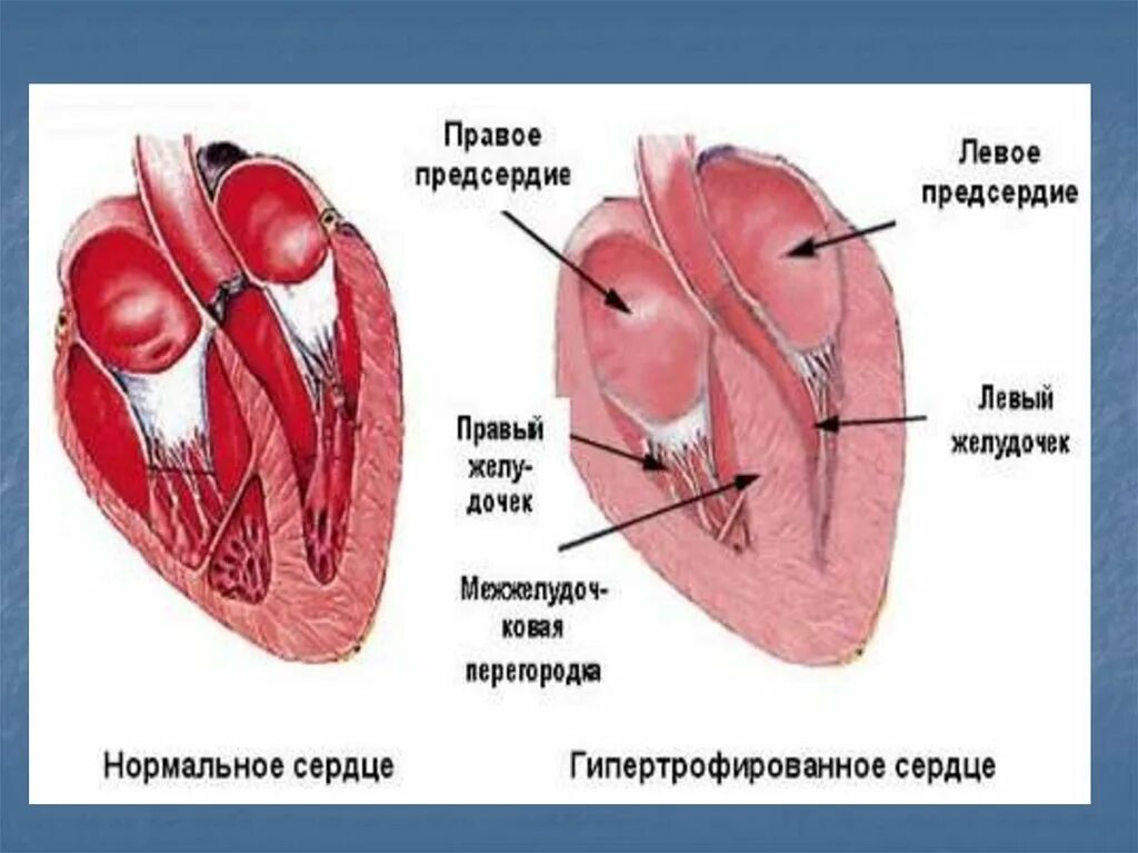 Миокардиодистрофия. Тонзиллогенная миокардиодистрофия. Дистрофический миокардит. Предсердие у животных