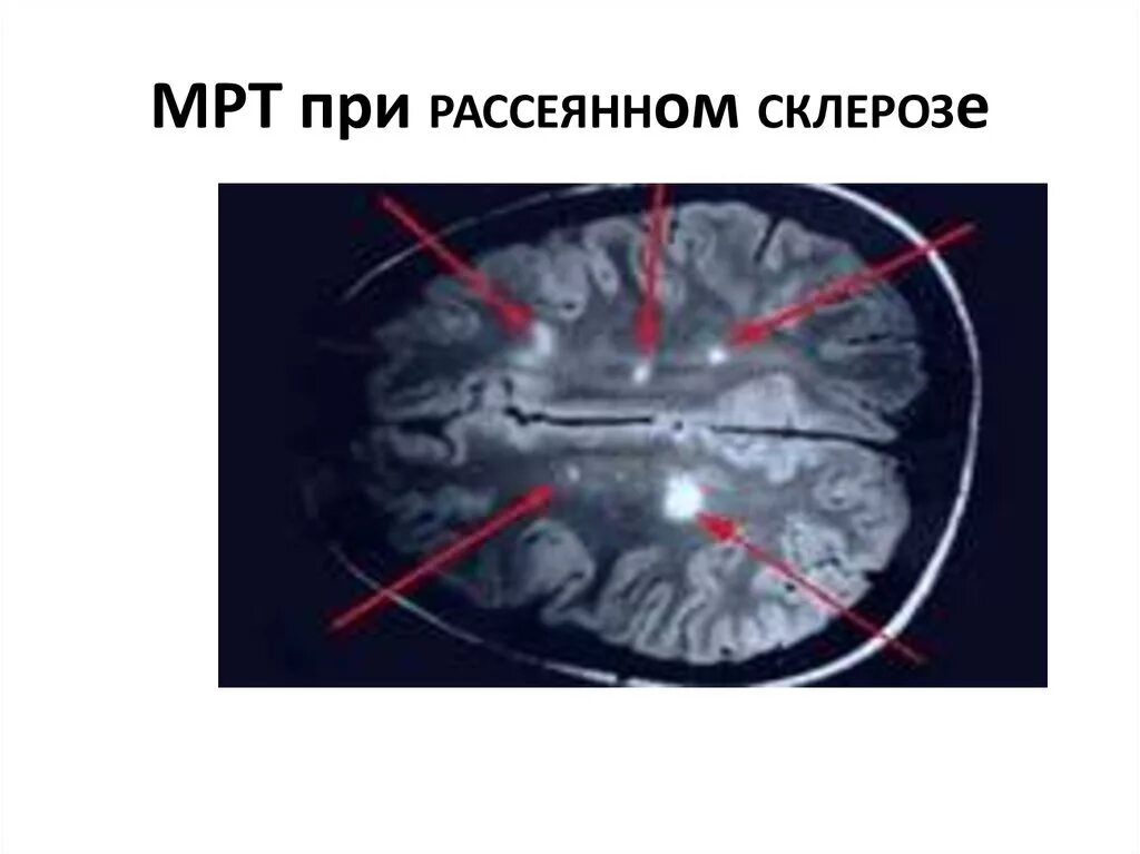 Склероз мозга. Мрт при рассеянном склерозе. Активный очаг при рассеянном склерозе что это. Рецидив рассеянного склероза. Очаги чего при рассеянном склерозе.