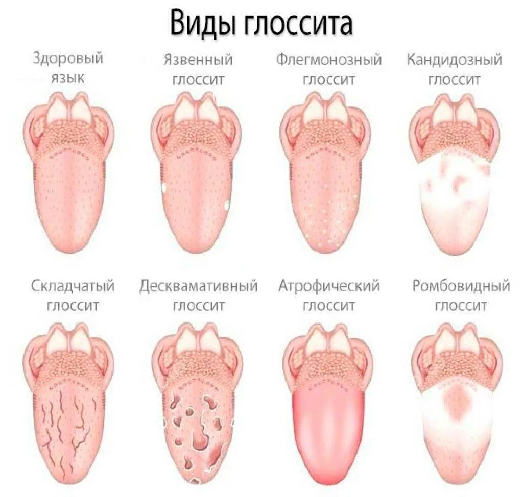 Язык признак какой болезни. Глоссит этиология патогенез. Десквамативный глоссит налет. Срединный ромбовидный глоссит.