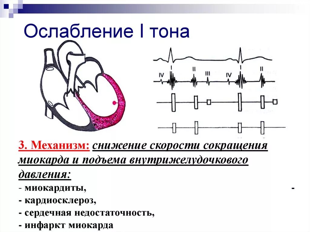 Ослабленные тоны сердца. Ослабление тонов сердца в норме и при патологии.. Ослабление и усиление 1 тона. Механизм ослабления 1 тона. ФКГ ослабление 1 тона.