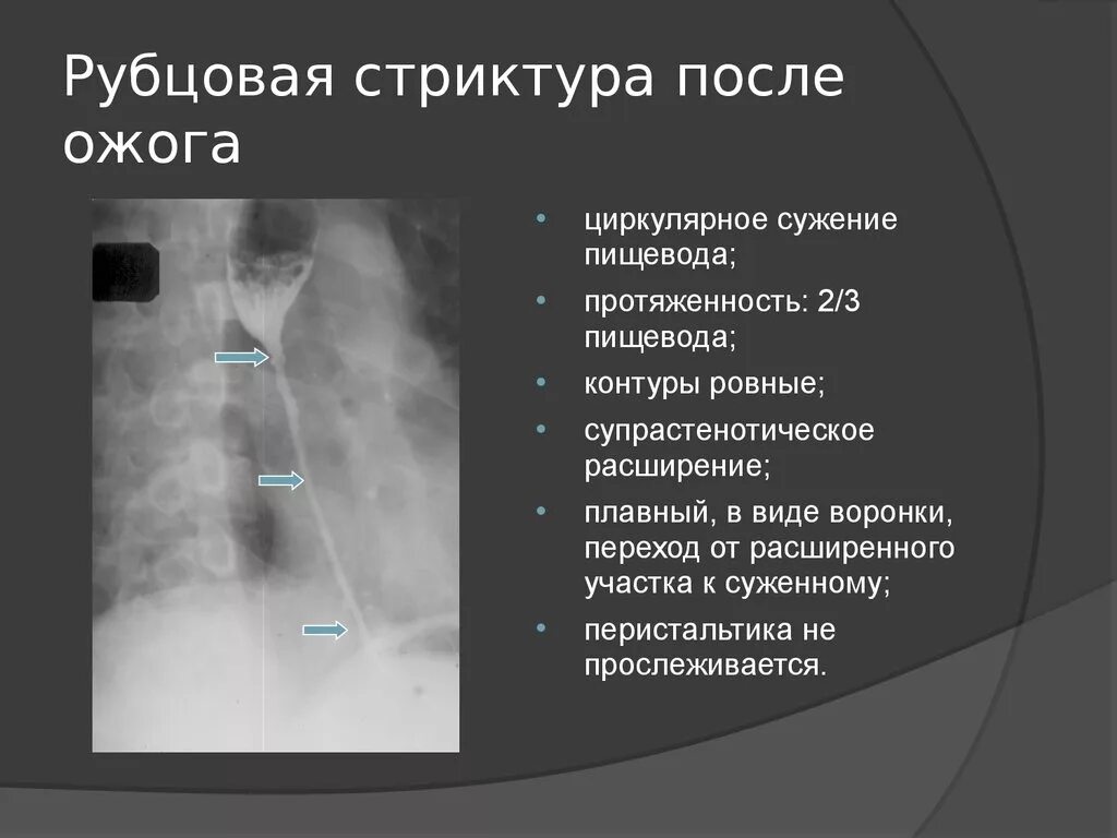 Рубцовые сужения пищевода