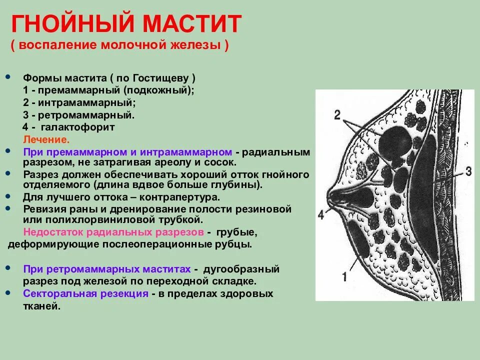 Формы гнойного воспаления. Субареолярный Гнойный мастит. Топографическая анатомия и Оперативная хирургия молочной железы. Интрамаммарный Гнойный мастит. Мастит топографическая анатомия.