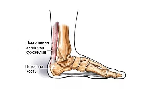 Воспаление ахиллова сухожилия. Ахиллово сухожилие на стопе. Симптомы тендинита ахиллова сухожилия. Тендинит сухожилия голеностопного сустава. Почему болят сухожилия пятки