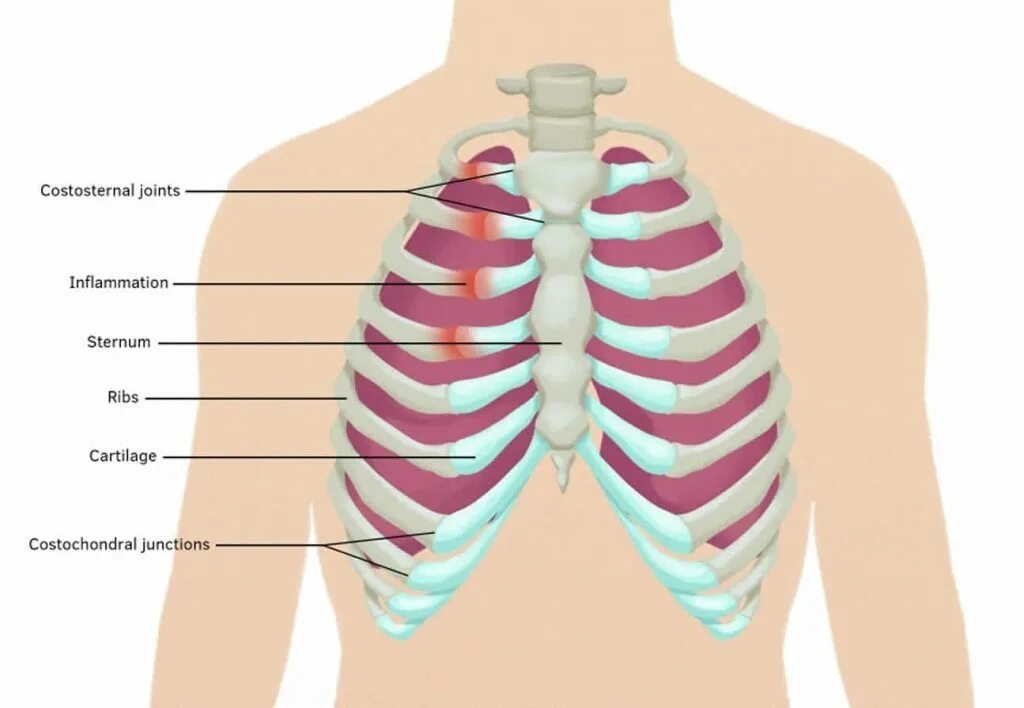 Синдром Титце хондрит реберный. Синдром Титце грудная клетка. Воспаление грудино-реберного сочленения. Синдром Титце воспаление грудинно реберного сочленения. Почему болят где ребра