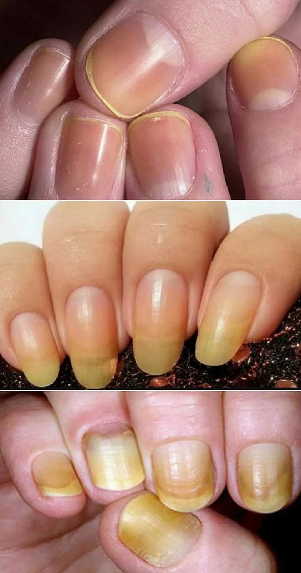 5 Fast Ways To Treat Discolored Nails Stained nails, Nail whitening, Yellow nail