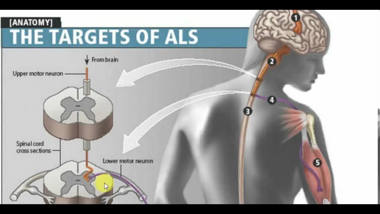 Боковой амиотрофический склероз причины заболевания. Боковой амиотрофический склероз. Боковой амиотрофический склеро. Амиотрофический латеральный склероз. Болезнь боковой амиотрофический склероз.