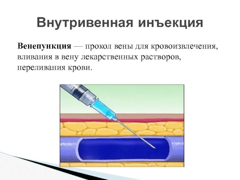 Внутривенно под каким углом. Алгоритм выполнения внутривенной инъекции алгоритм. Внутривенная инъекция алгоритм выполнения. Алгоритм при инъекции в Вену. Внутривенная инъекция глубина введения иглы.