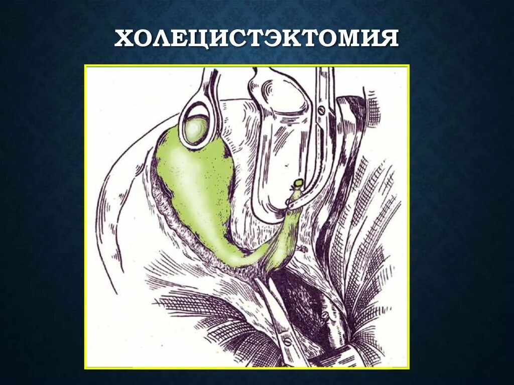 Виды холецистэктомии