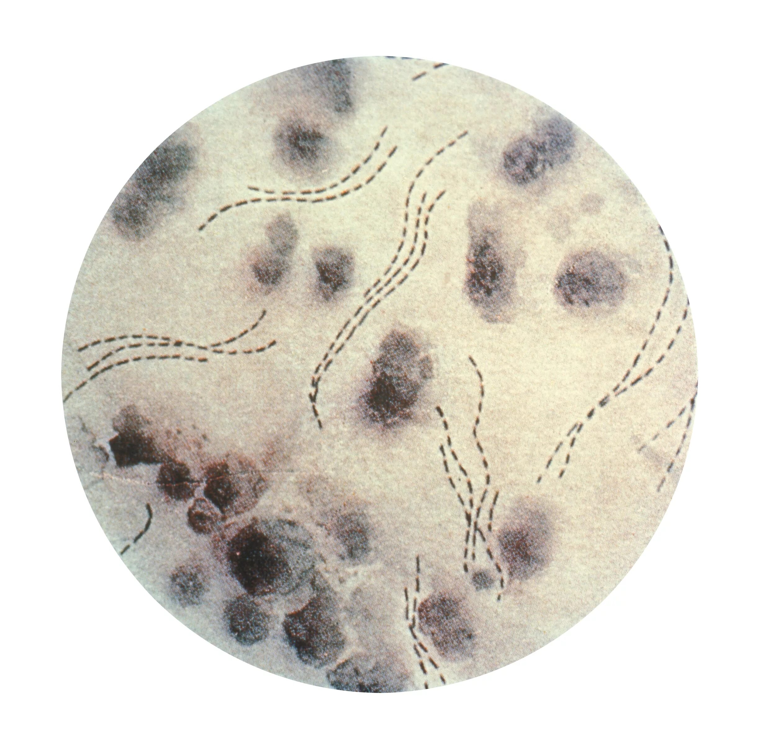 Haemophilus в мазке у мужчин. Стрептобациллы Дюкрея.