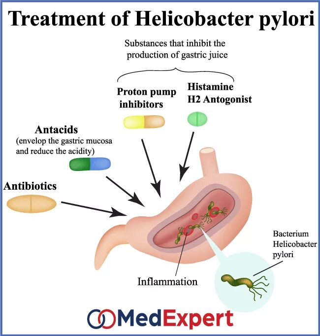 Ифа helicobacter pylori. Ифа helicobacter pylori