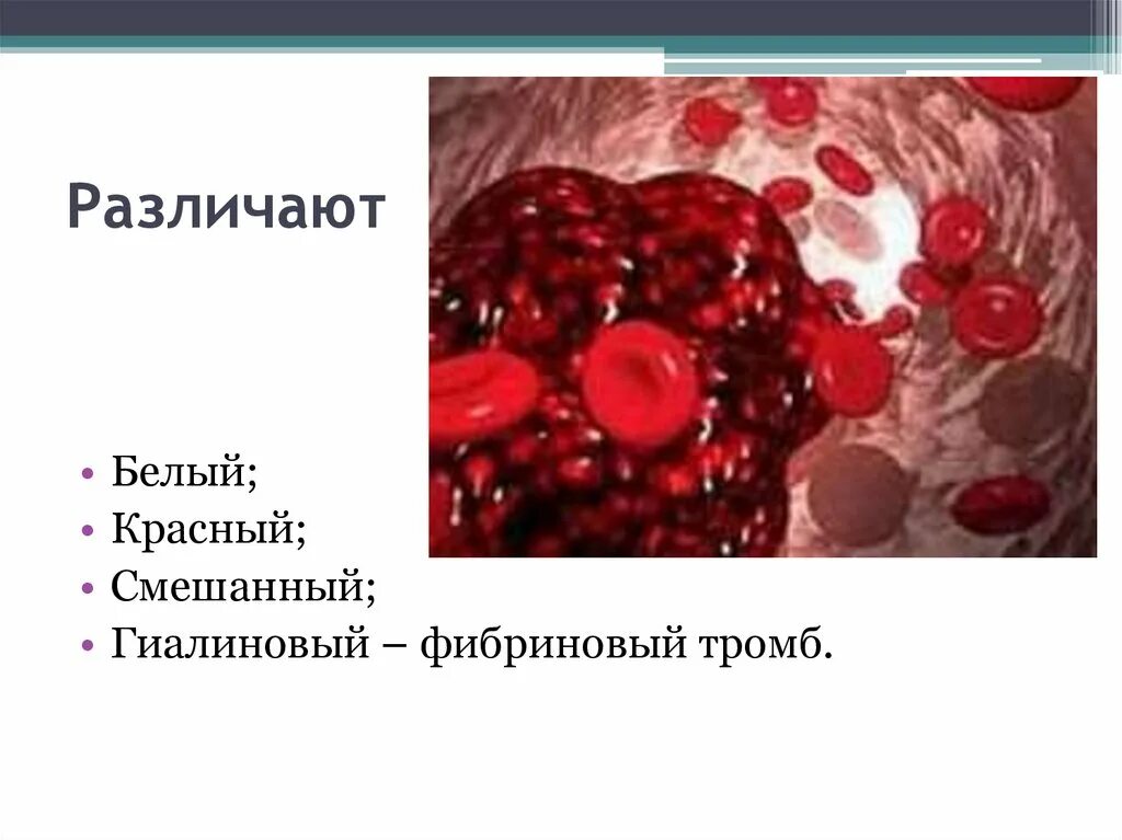 Тромб и эмбол. Фибриновый и гиалиновый тромбы. белые красные и смешанные тромбы. белый красный и смешанный тромбы.
