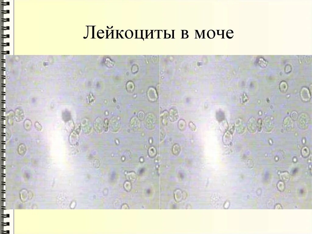 Микроскопия мочи лейкоциты. Нечипоренко микроскопия. Лейкоциты в моче микроскопия осадка. Лейкоциты и эритроциты в моче микроскопия.