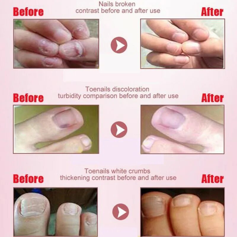 онихолизис синегнойная. микотическая лейконихия. поврежденная ногтевая пластина. ониходистрофия - онихолизис. грибок ногтей после гель лака чем лечить.