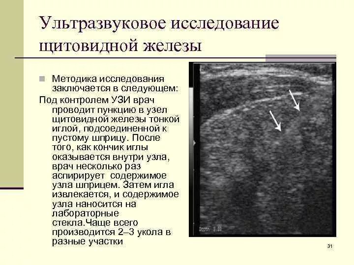 Ли узи. УЗИ щитовидной железы показания. Метод исследования щитовидной железы УЗИ. Сонограммы щитовидной железы. УЗИ щитовидной железы патология.