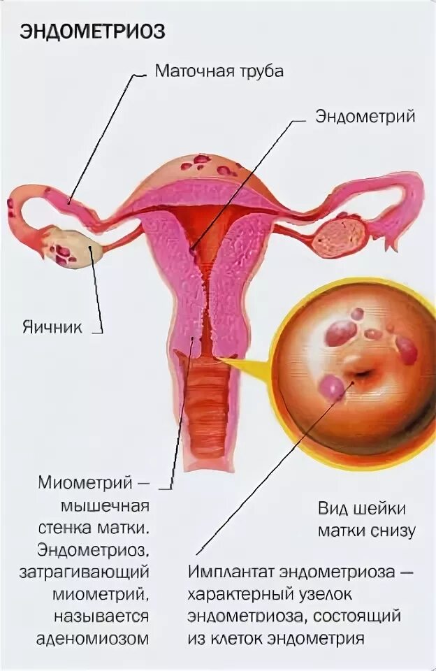 Эндометриоз стенки матки. Женское заболевание эндометриоз.