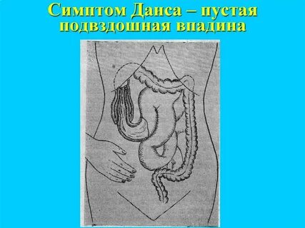 Симптом вале