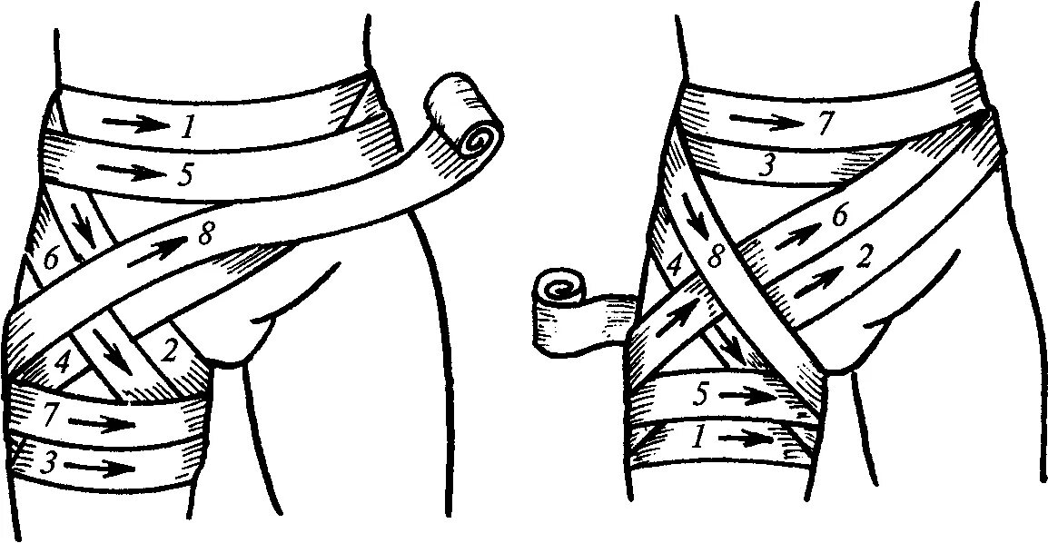 Колосовидная повязка на тазобедренный сустав. Колосовидная перевязка на бедро. Как бинтовать бедро эластичным бинтом. Колосовидные повязки применяются для. Как перебинтовать эластичным