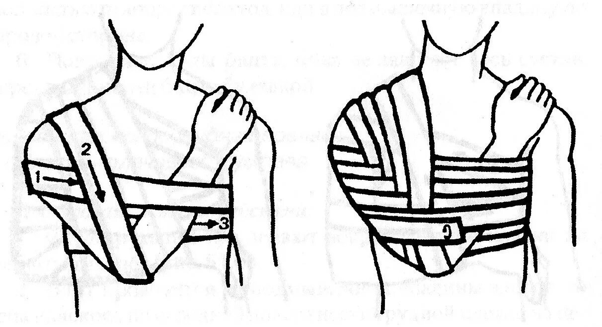 Плечевая повязка алгоритм. Повязка Вельпо техника. Наложение повязки Вельпо. Повязка Вельпо алгоритм наложения. Повязка Дезо и Вельпо.