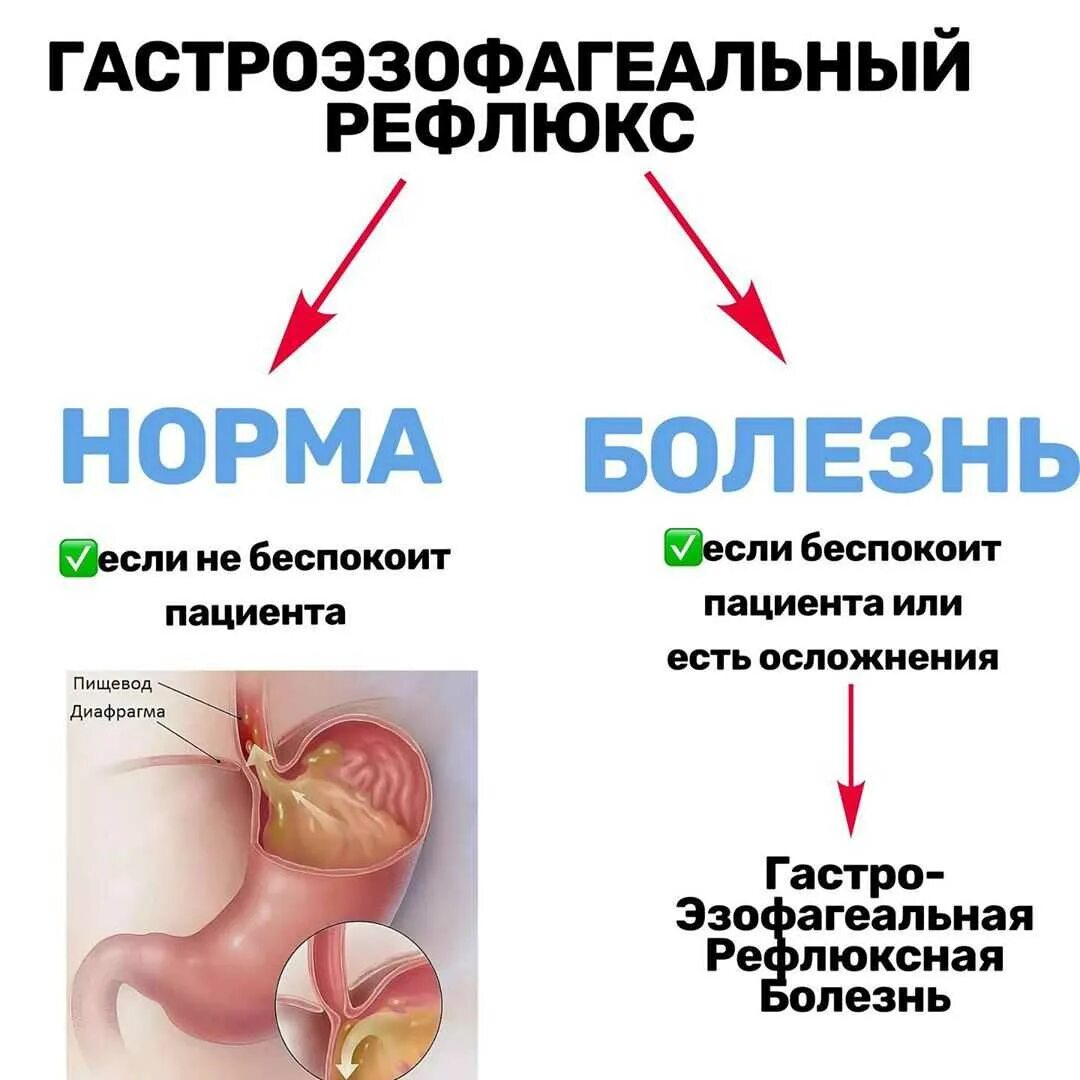 Заброс кислоты из желудка в пищевод