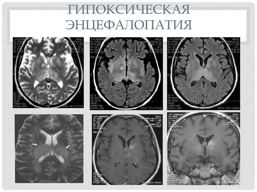 Резидуальная органическая головного мозга. Резидуальная энцефалопатия мрт. Аноксическая энцефалопатия. Постгипоксическая энцефалопатия кт. Мрт ишемическая энцефалопатия.