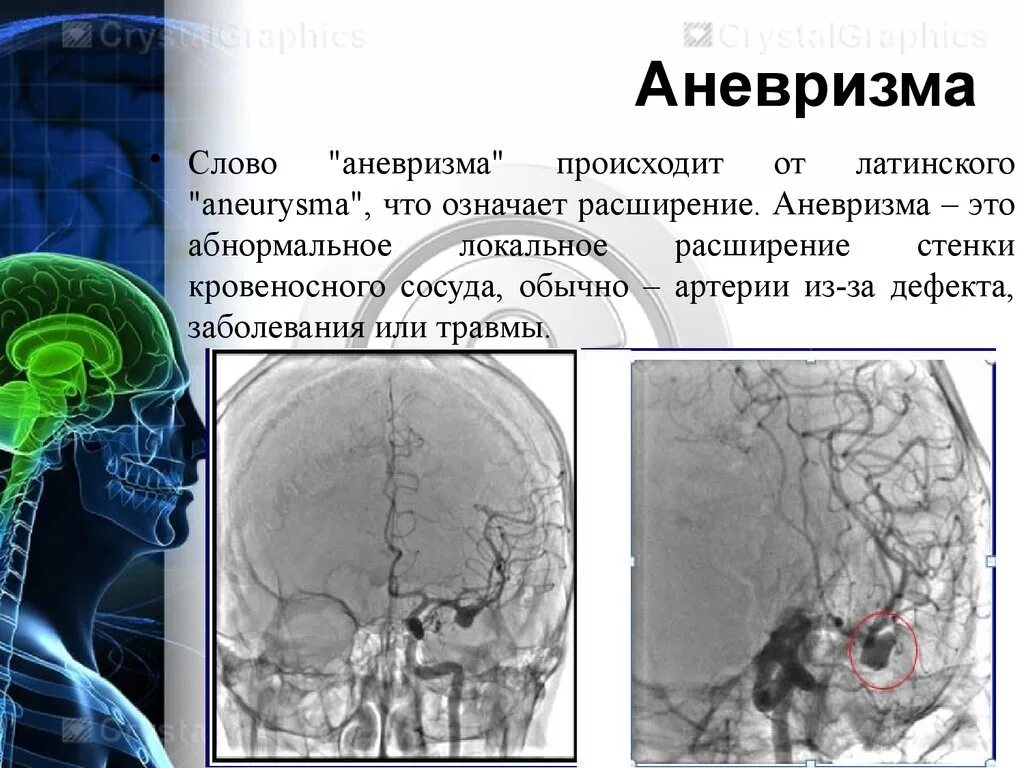 Аневризма мозга отзывы. Аневризма сосудов головного мозга. Аневризмы сосудов мозга. Симптомы аневризмы головного мозга. Аневризма головного мозга симптомы.