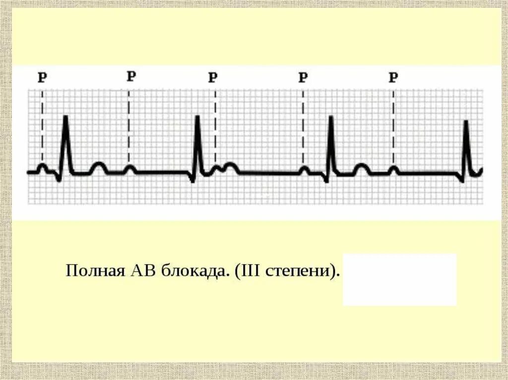 Полная атриовентрикулярная блокада. Полная av блокада на ЭКГ. Атриовентрикулярная блокада 3 степени на ЭКГ. Полная АВ блокада 3 степени ЭКГ. ЭКГ АВ блокада 1.